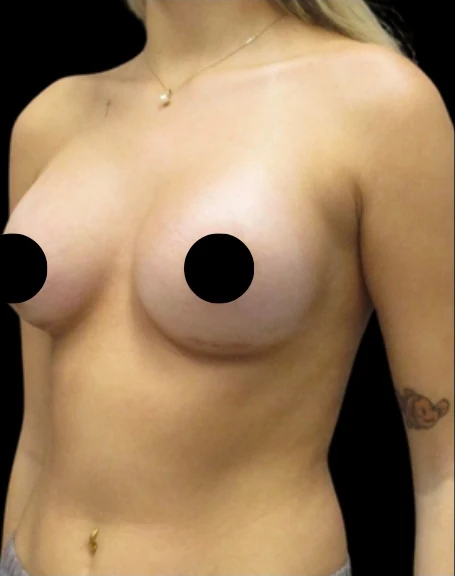 After: Breast Augmentation — front · by Dr. Champion