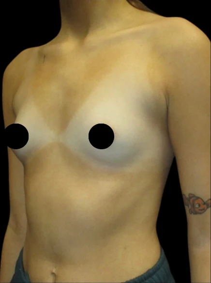 Before: Breast Augmentation — front · by Dr. Champion