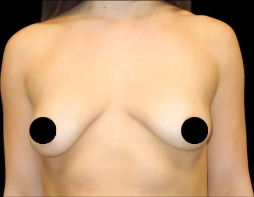Before: Breast Augmentation — front · by Dr. Cuzalina
