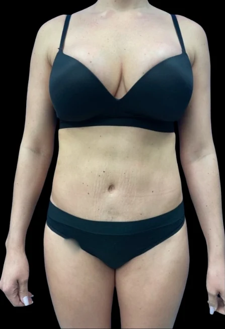 Before: Breast Aug & Hidef Lipo — front · by Dr. Tolomeo