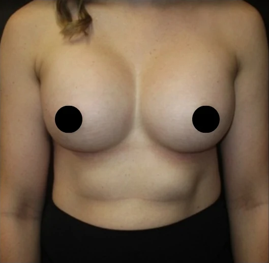 After: Breast Augmentation — front · by Dr. Cuzalina