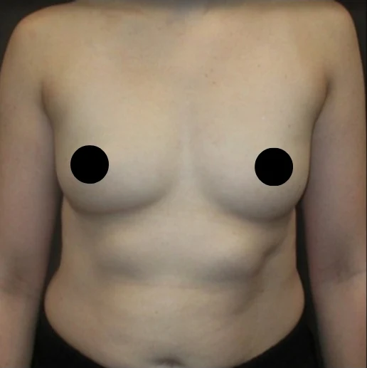 Before: Breast Augmentation — front · by Dr. Cuzalina
