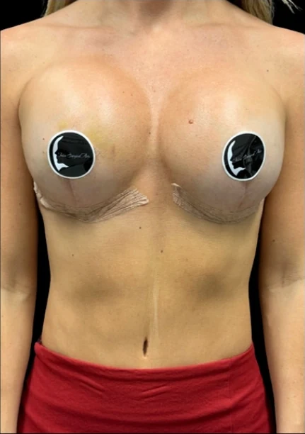 After: Breast Augmentation — front · by Dr. Cuzalina