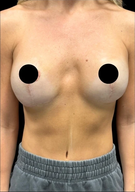 Before: Breast Augmentation — front · by Dr. Cuzalina