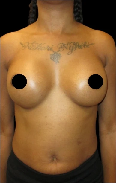 After: Breast Augmentation — front · by Dr. Cuzalina