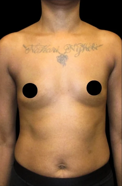 Before: Breast Augmentation — front · by Dr. Cuzalina