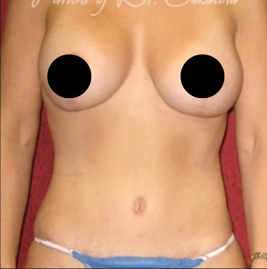 After: Breast Aug/Lift, Tummy Tuck, Lipo360 — front · by Dr. Cuzalina