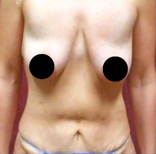 Before: Breast Aug/Lift, Tummy Tuck, Lipo360 — front · by Dr. Cuzalina
