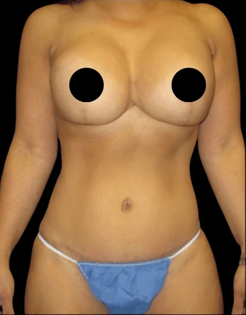 After: Breast Aug/Lift, Tummy Tuck, Lipo360 — front · by Dr. Cuzalina