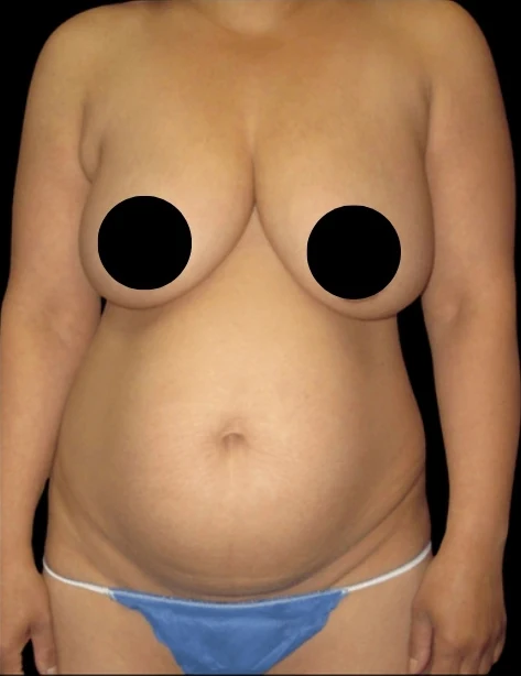 Before: Breast Aug/Lift, Tummy Tuck, Lipo360 — front · by Dr. Cuzalina