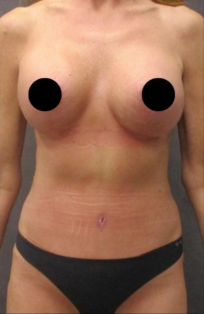 After: Breast Aug/Lift, Tummy Tuck, Lipo360 — front · by Dr. Cuzalina