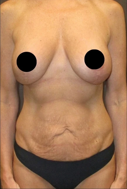 Before: Breast Aug/Lift, Tummy Tuck, Lipo360 — front · by Dr. Cuzalina