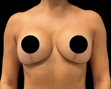 After: Breast Aug/Lift — front · by Dr. Cuzalina