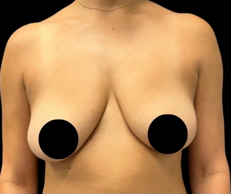 Before: Breast Aug/Lift — front · by Dr. Cuzalina