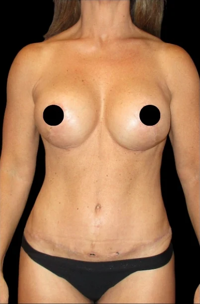 After: Breast Aug/Lift, Tummy Tuck, Lipo360 — front · by Dr. Cuzalina