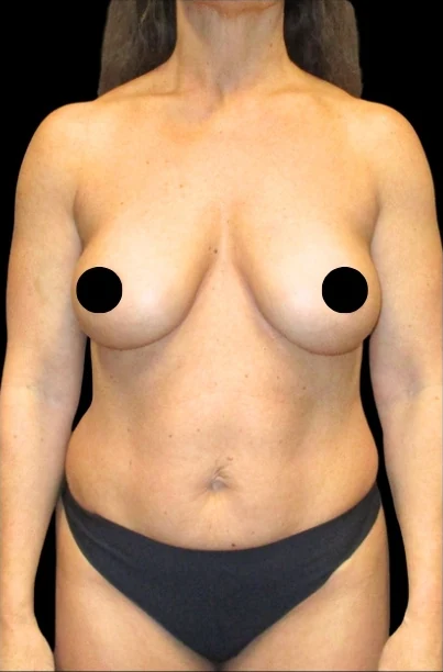 Before: Breast Aug/Lift, Tummy Tuck, Lipo360 — front · by Dr. Cuzalina